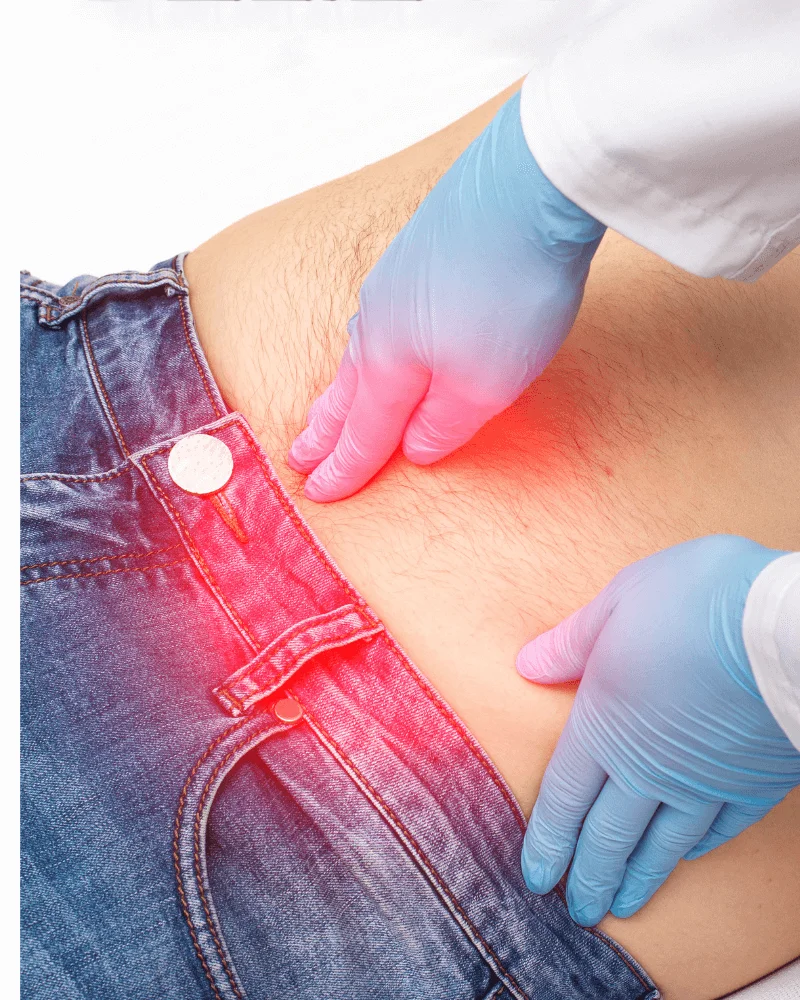 cirujano-de-hernias-en-Zapopan