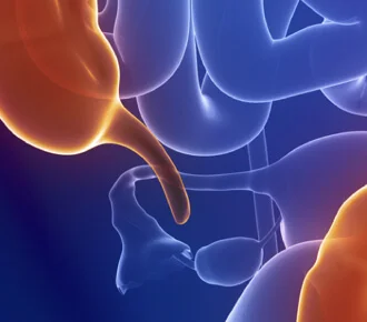 Apendicectomía Abierta o Laparoscópica