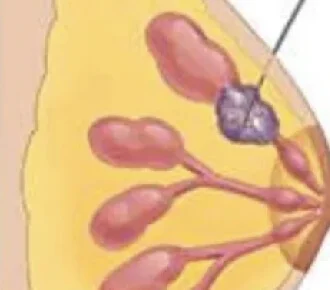 Biopsias o Reseccion de Mama 
