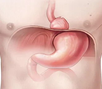 Funduplicatura por Hernias de Hiato