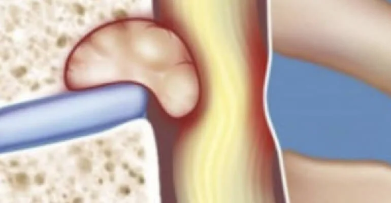 Resección de tumores de partes blandas y hueso